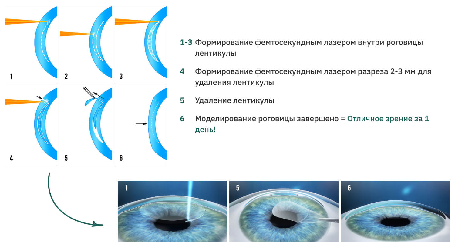 Лазерная коррекция зрения SmartSight в Нижнем Новгороде