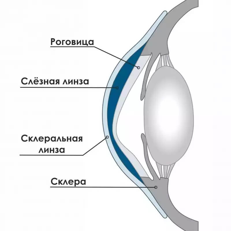 положение склеральной линзы в глазу