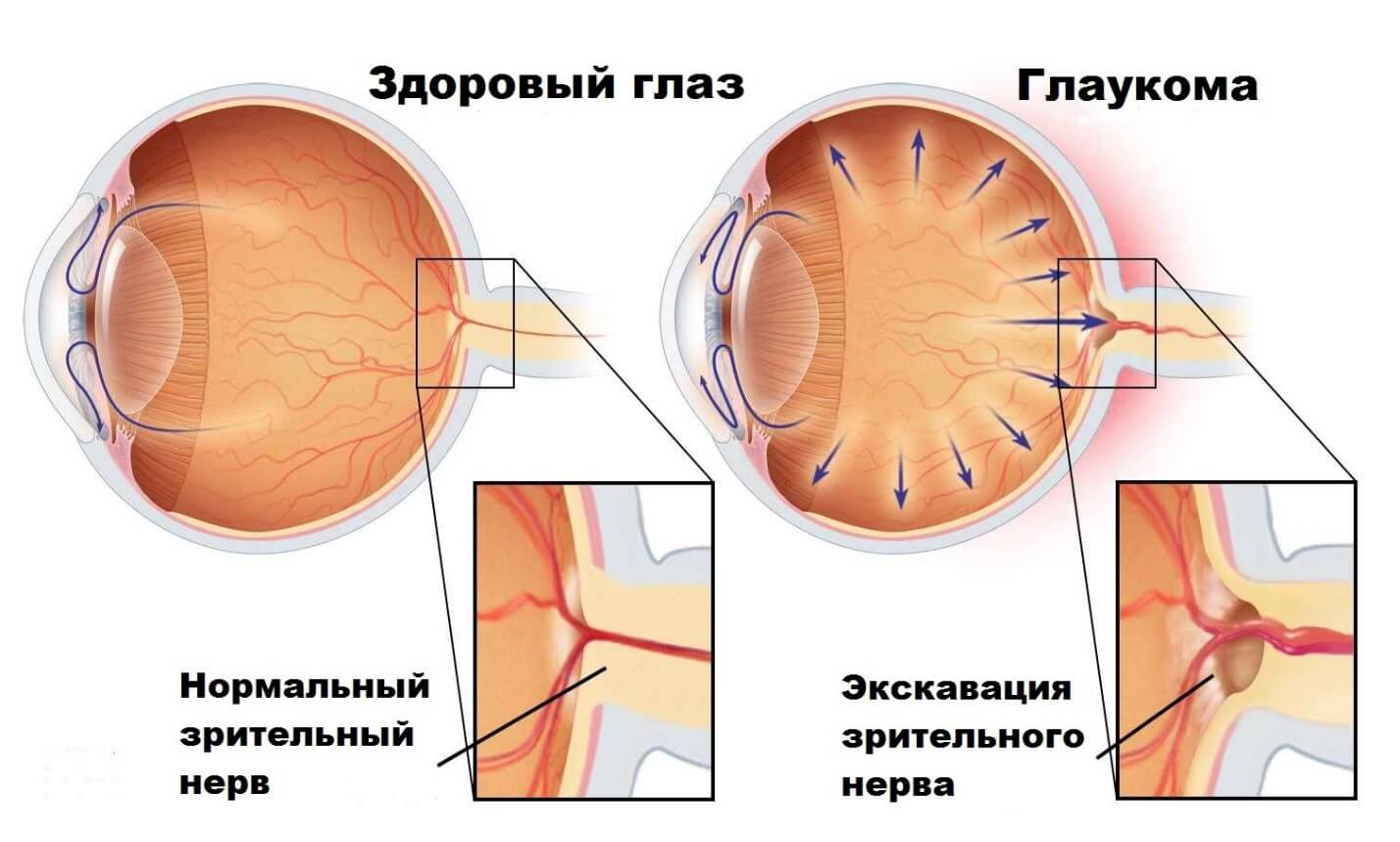 Можно вернуть зрение при глаукоме. Глаукома, повышенное внутриглазное давление. Глаукома строение глаза. Закрытоугольная глаукома глаза. Открытоугольная глаукома симптомы.