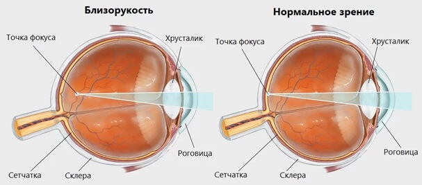 глаз при близорукости и при нормальном зрении