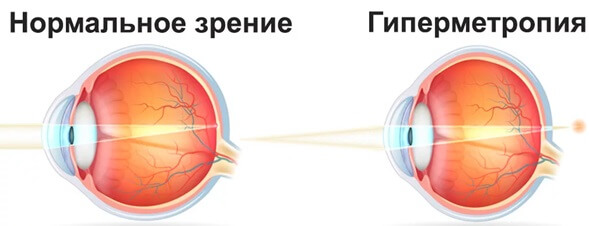 нормальное зрение и зрение при гиперметропии