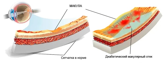 строение сетчатки и диабетический макулярный отек