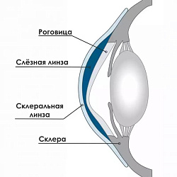 Cклеральные линзы. Cпособ коррекции зрения для тех, кому ничего другое не подходит