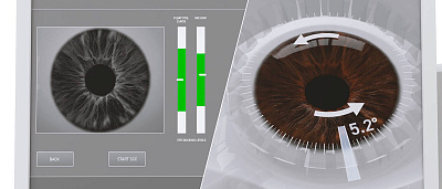 Лазерная коррекция зрения SmartSight