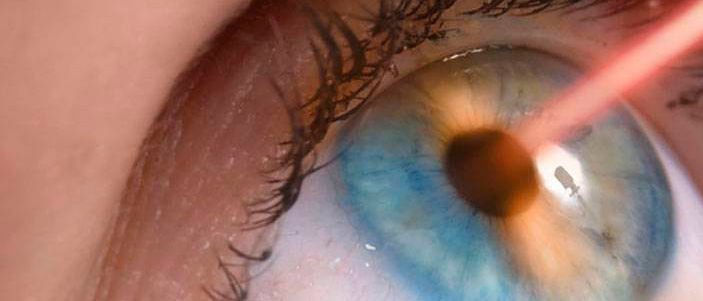 Лазерное лечение заболеваний и отека роговицы