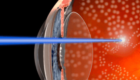Лазерное лечение диабетической ретинопатии