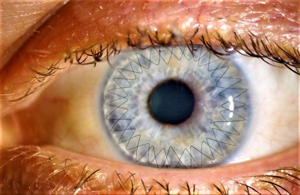 Кератопластика и виды