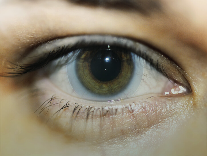 Жесткие склеральные контактные линзы