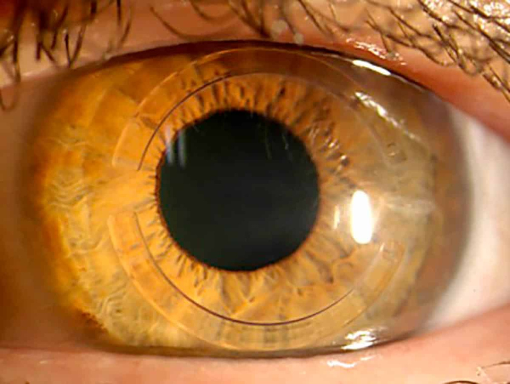 Операция имплантации интрастромальных колец