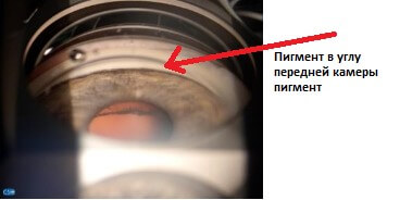 глаукома пигмент в углу передней камеры