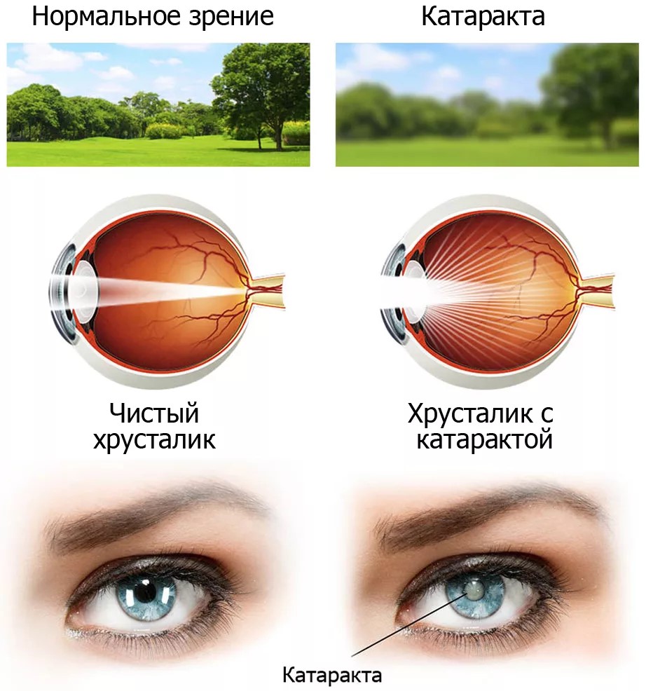 катаракта хрусталик