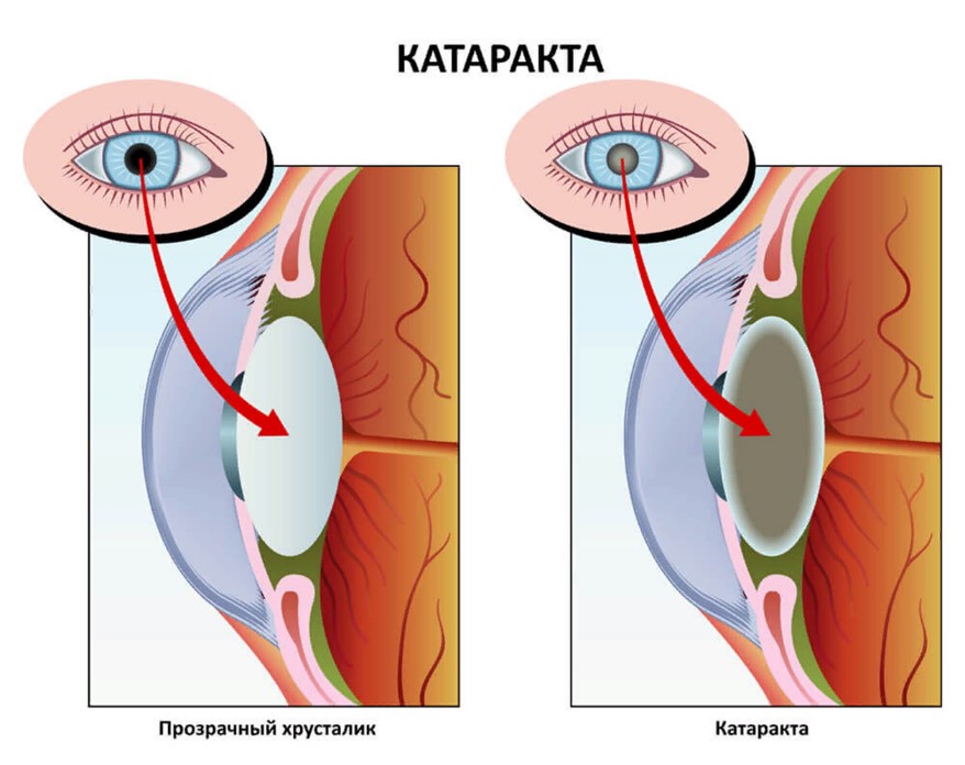 катаракта и нормальное зрение
