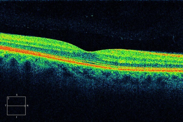 Оптическая когерентная томография сетчатки здорового глаза