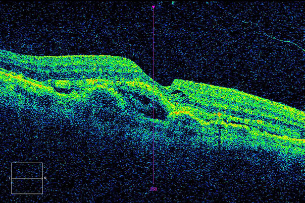 Оптическая когерентная томография сетчатки глаза пациента с ВМД