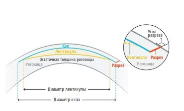 лазерная коррекция зрения методом SmartSight