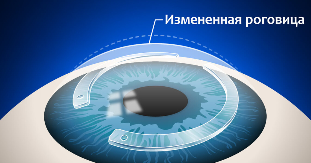измененная роговица